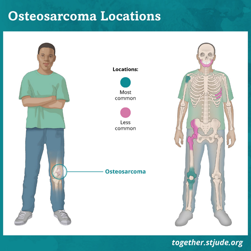 Os sintomas de osteossarcoma dependem de onde o tumor está localizado. Os locais mais comuns para o desenvolvimento do osteossarcoma são próximos ao joelho, na parte inferior do fêmur ou na parte superior da tíbia. Outro local comum para o desenvolvimento do osteossarcoma é no úmero, que fica próximo ao ombro. O osteossarcoma também pode se desenvolver na pelve ou no crânio.