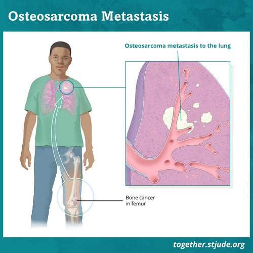 O osteossarcoma metastático significa que o câncer se espalhou para outros lugares, como os pulmões ou outros ossos. O lugar mais comum para o osteossarcoma se espalhar é o pulmão.