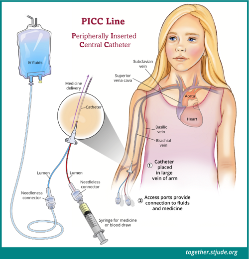 والقسطرة المركزية المدخلة طرفيًا (PICC) عبارة عن قسطرة يتم إدخالها في وريد داخل منطقة العضد وتمتد إلى وريد أكبر يتجه إلى القلب. يظل أحد أطراف القسطرة خارج الجلد ويحتوي على أنبوب أو اثنين يُسميان تجويفين.