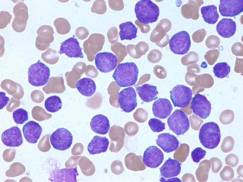 Image de la moelle osseuse d’un patient atteint de leucémie aiguë lymphoblastique examinée au microscope