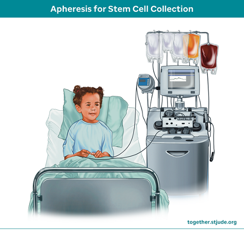 Female child undergoing apheresis procedure for stem cell collection