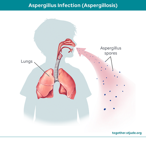 Infección por Aspergillus
