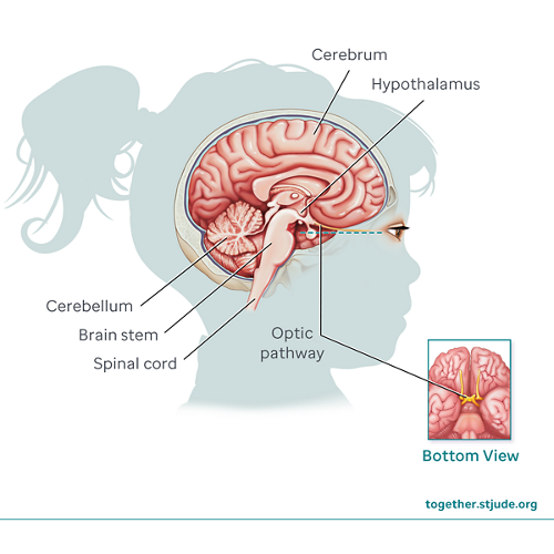 Ilustración médica detallada de un tumor de astrocitoma y la anatomía del cerebro