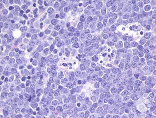 Células de linfoma de Burkitt según se observan en un microscopio. 