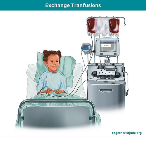 exanguinotransfusiones
