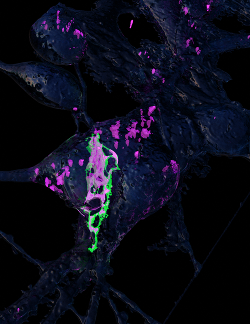 Junctions between two potentially cancerous neurons 