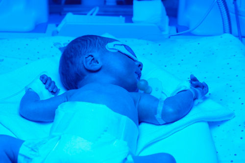 bebé bajo la luz de la fototerapia 