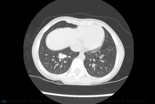 A tomografia computadorizada de tórax de um jovem paciente com osteossarcoma mostra sinais de doença metastática.