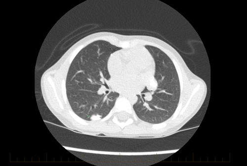 A tomografia computadorizada de tórax de um jovem paciente com osteossarcoma mostra sinais de doença metastática.