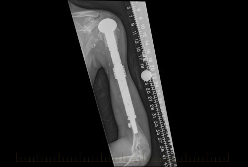 Radiografia do úmero três anos após a cirurgia de preservação do membro.