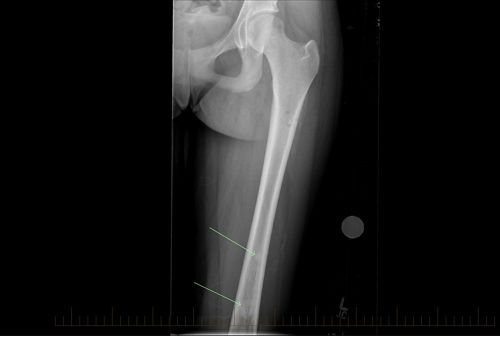 A radiografia mostra uma visão lateral, ou de perfil, de lesões em salto causadas por osteossarcoma no fêmur de um paciente.