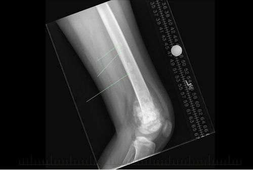 A radiografia mostra uma visão ântero-posterior (da frente para trás) de lesões em salto causadas por osteossarcoma no fêmur de um paciente.