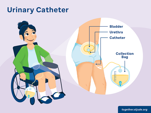 وہیل چیئر پر بیٹھی بچی کی تصویر جس میں یورینری کیتھیٹر کے مختلف حصے دکھائے گئے ہیں، جن میں مثانہ، یوریتھرا، کیتھیٹر، اور کلیکشن بیگ شامل ہیں