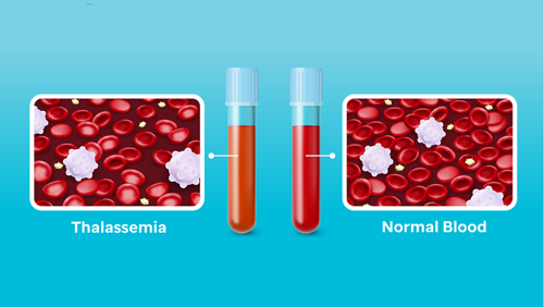 Thalessemia illustration