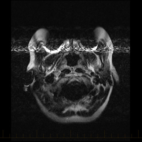 Resonance Imaging (MRI) for Childhood Cancer Together