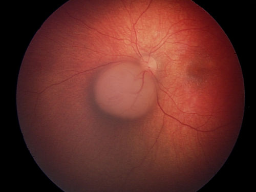 This is an EUA picture of retinoblastoma tumor group B. Tumor group B has low risk of losing the eye. Group B includes a larger tumor that is located near important structures.